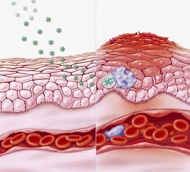 Anti-inflammatory effect of Alpha-Bisabolol